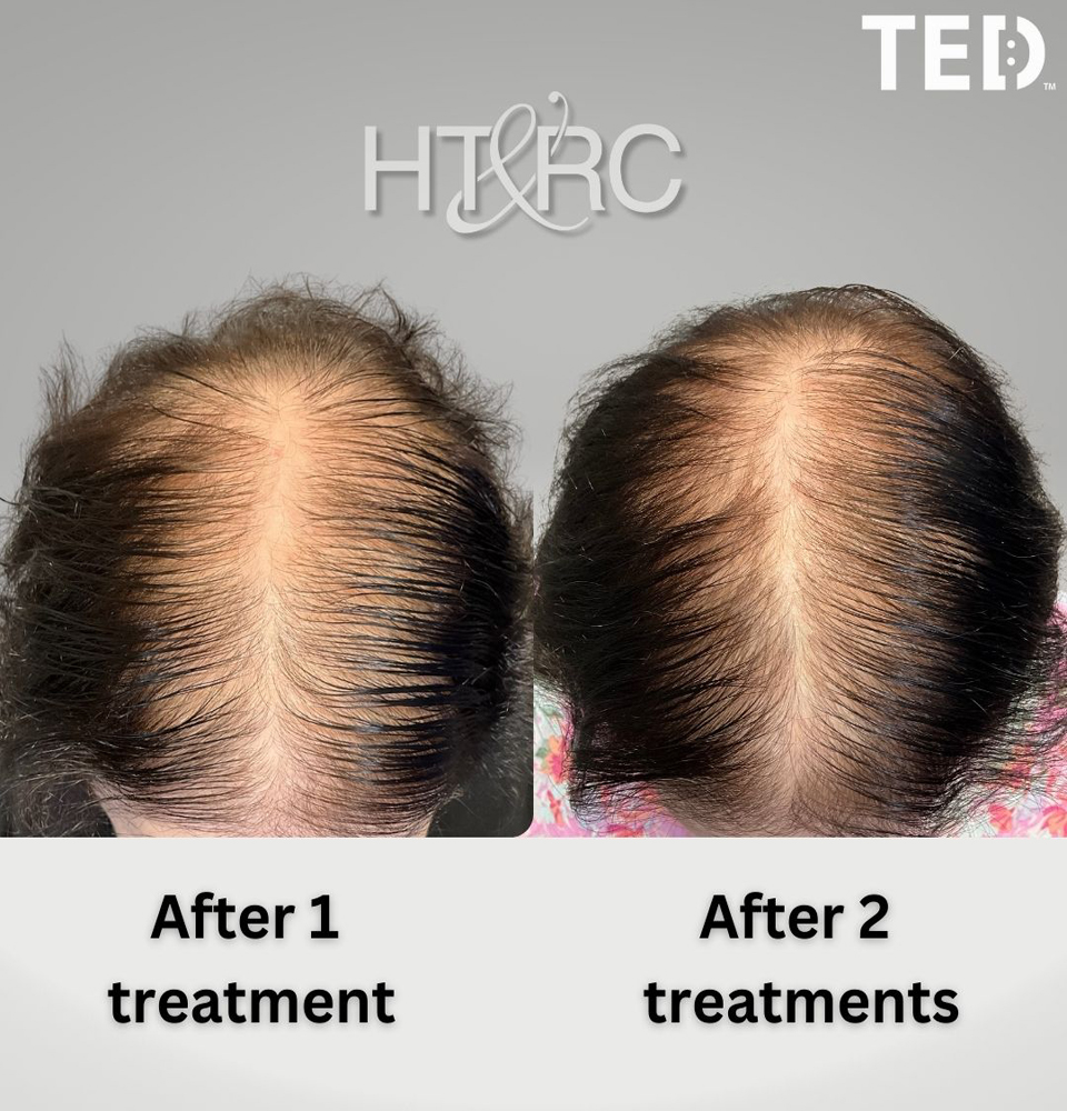 Can Losing Weight Cause Hair Loss