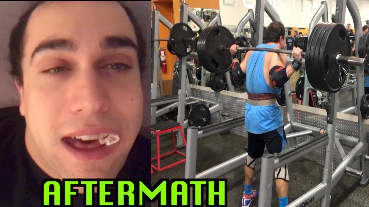 Can You Gym After Wisdom Teeth Removal