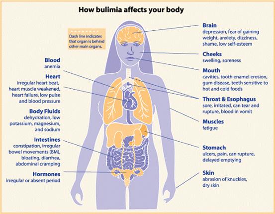Does Bulimia Cause Weight Loss