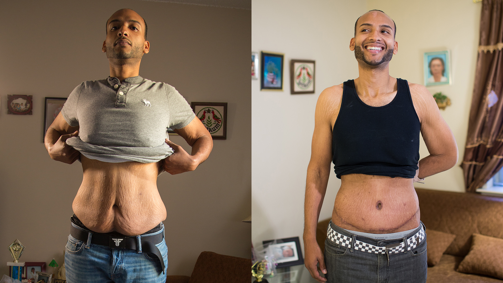 Does Skin Shrink After Weight Loss